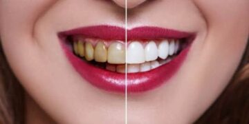 How Long Does Teeth Whitening Last?