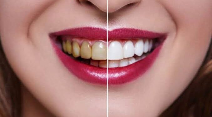 How Long Does Teeth Whitening Last?