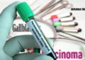 alzheimer blood test